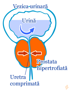 Adenom de prostata - hipertrofie prostatica benigna