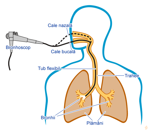 Bronhoscopie