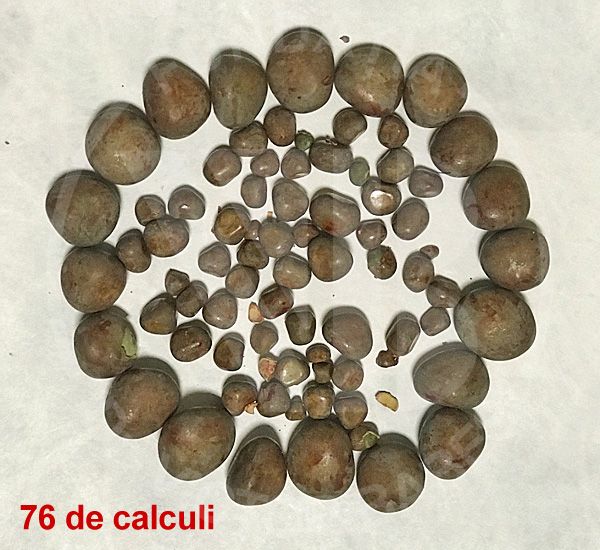 Calculi vezicali