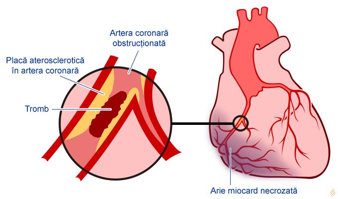 Infarctul miocardic