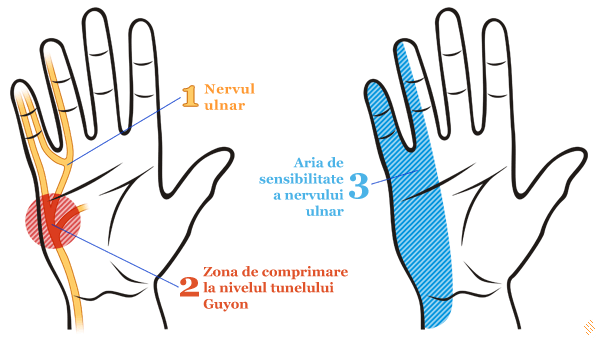 Neuropatia nervului ulnar - canal Guyon