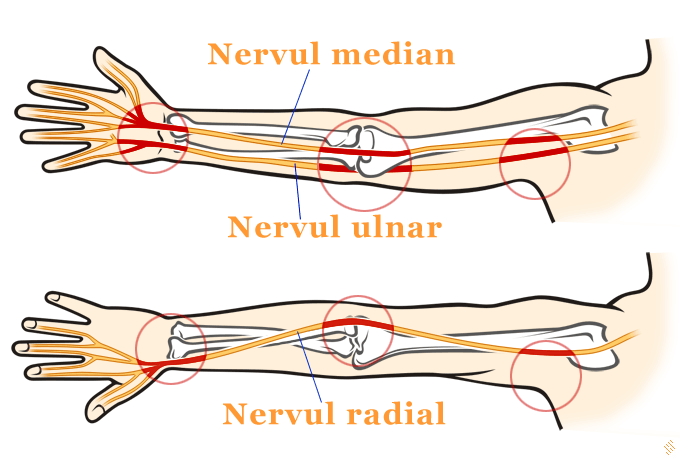 Neuropatia periferica