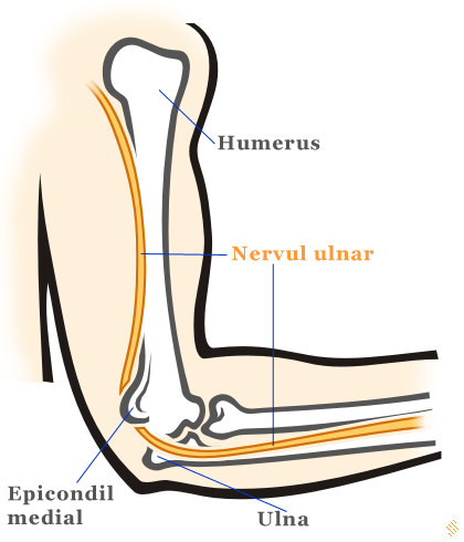 Neuropatia ulnara la cot