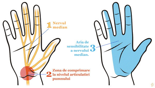 Sindromul de canal carpian