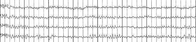 Electroencefalograma