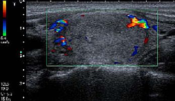 Examinare Doppler color