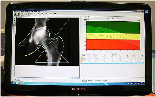 Rezultat electronic test osteodensitometrie